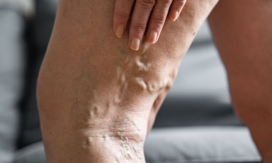 Zdjęcie poglądowe przedstawiające żylaki nóg