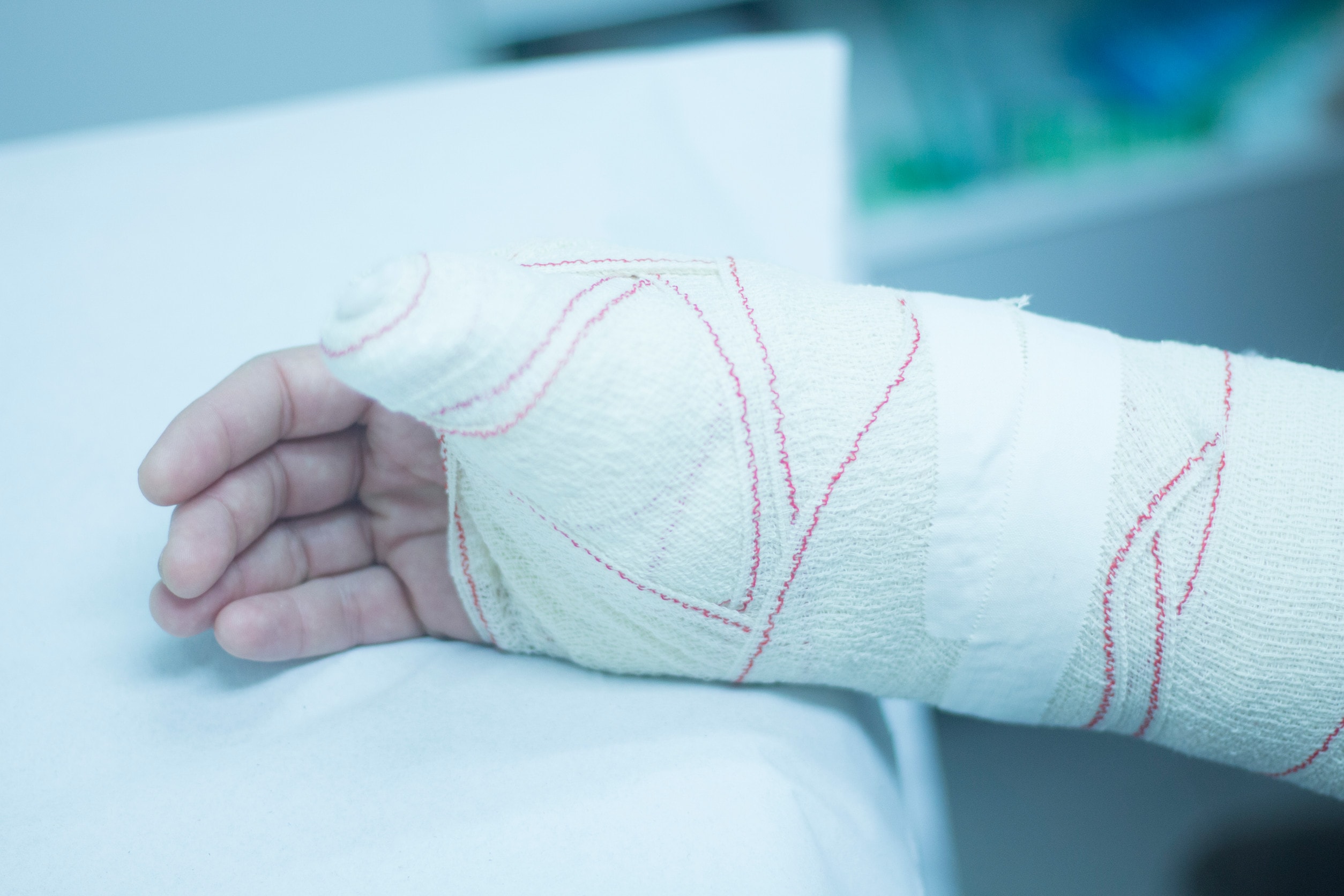 An arm wrapped in a cast resting on a table.