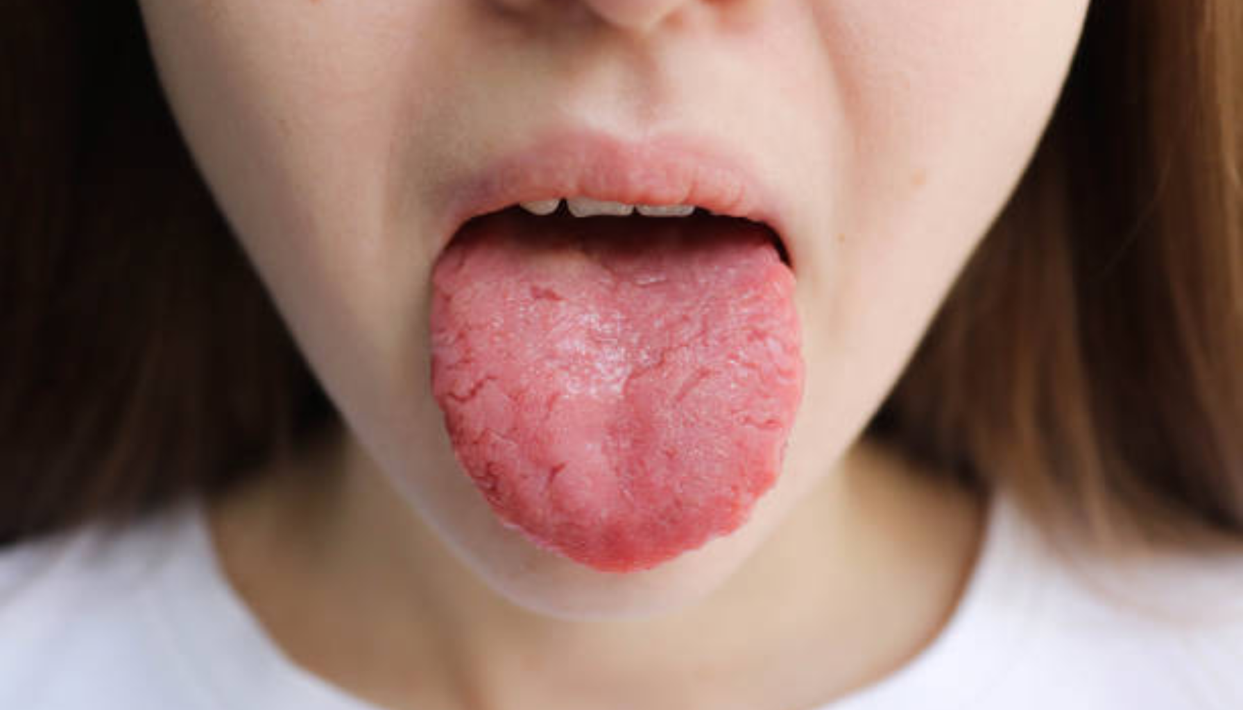 Glossitt: Betennelse i tungen Glossitt: Betennelse i tungen