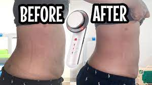 Ultrasonic Fat Cavitation Before And After | Fat Cavitation Before And  After Results | AMAZING! - YouTube