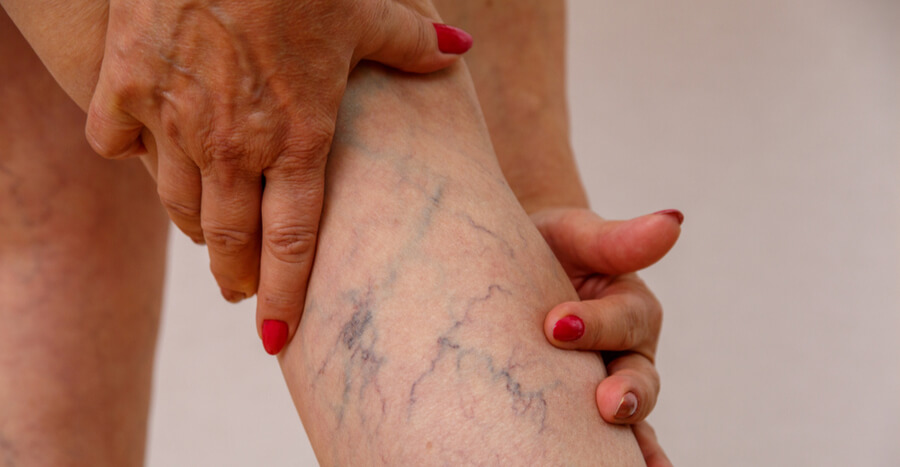 Vein Treatment At Vascular Institute