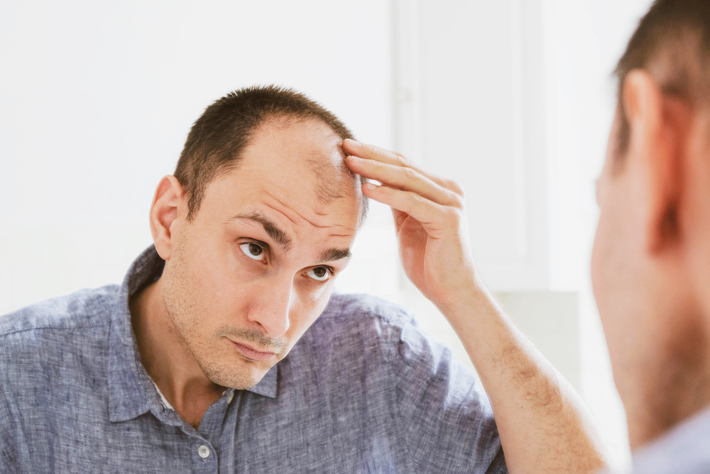Man with hair loss and receding hairline looking in mirror