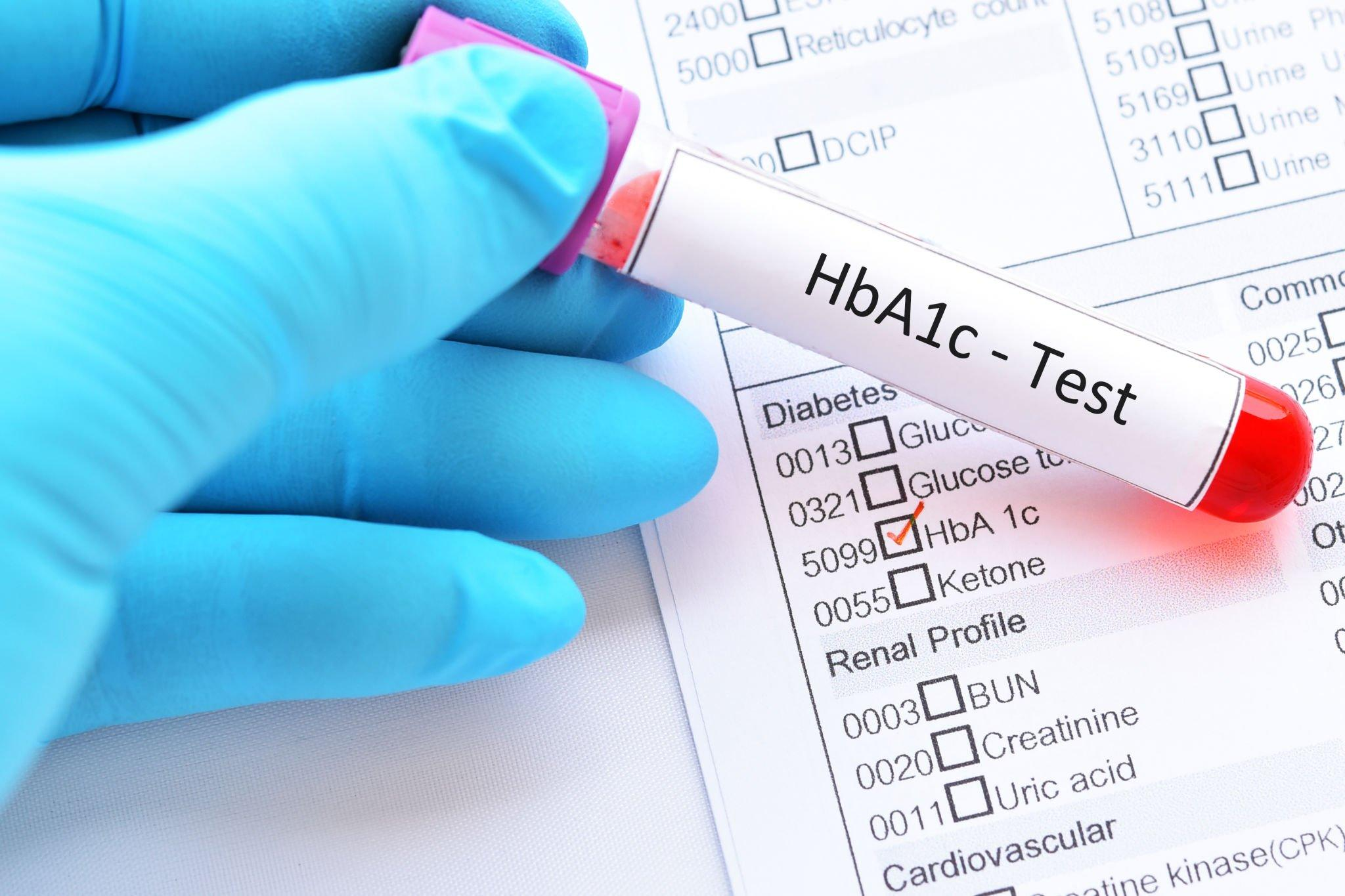 A person holding a test tube of blood for the glucose tests specifically Hemoglobin A1c test, which measures the low, high blood sugar, and average blood glucose level over time.