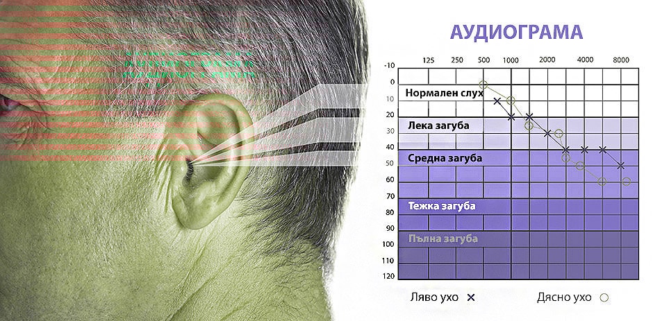 Изображение на човешко ухо и аудиограма с различни нива на загуба на слух