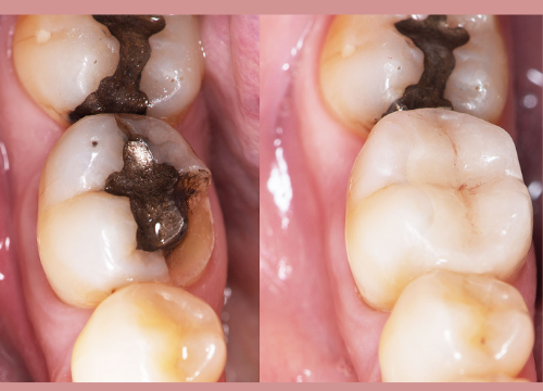 Black Stains on Teeth Causes Remedies and Treatment