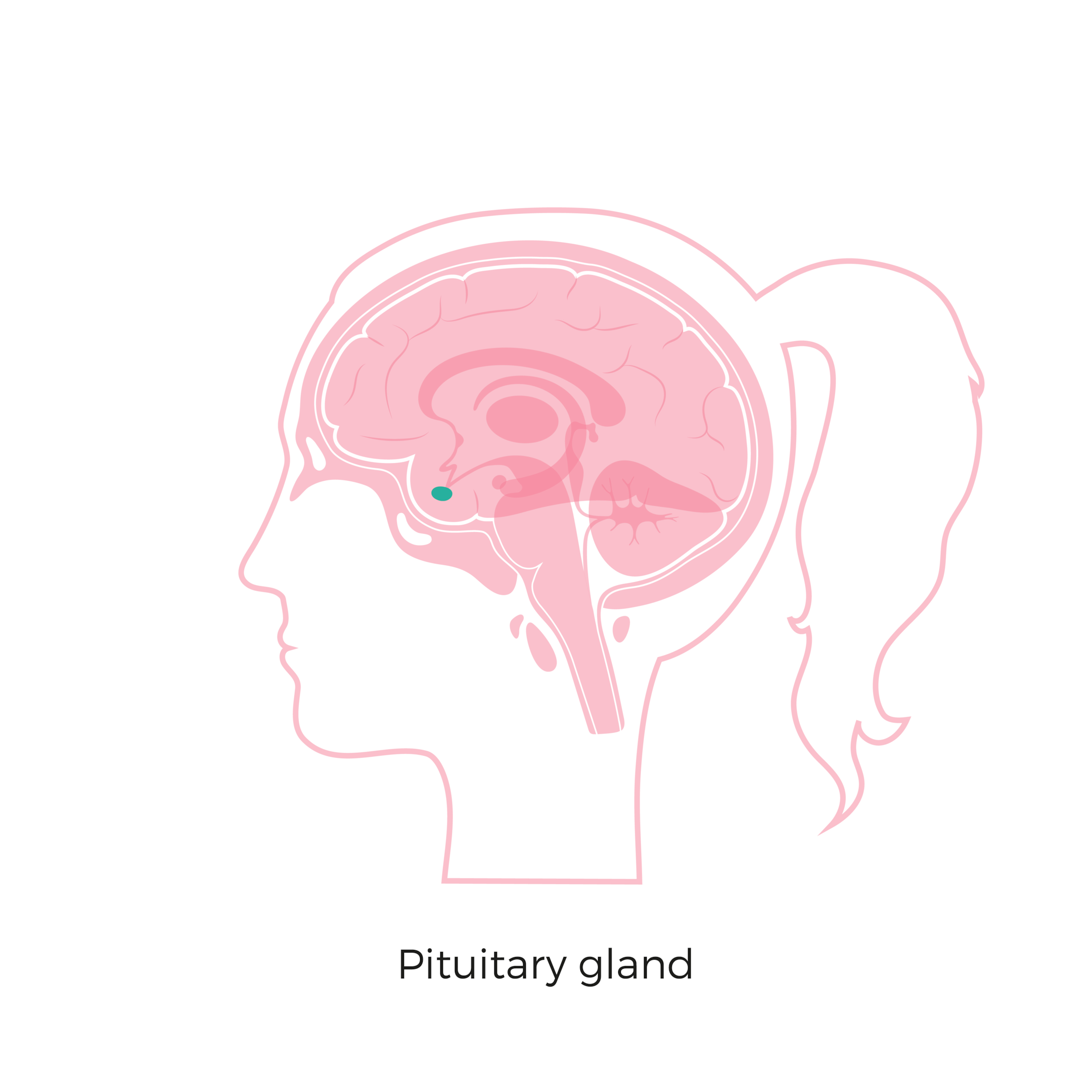 what causes pituitary tumors and how do pituitary gland tumors affect prolactin production 