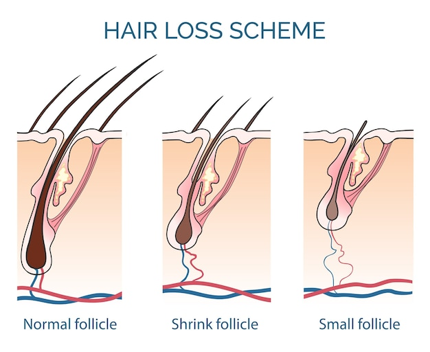 Loss of blood supply and nutrition will cause the hair follicles to shrink and ultimately die out.