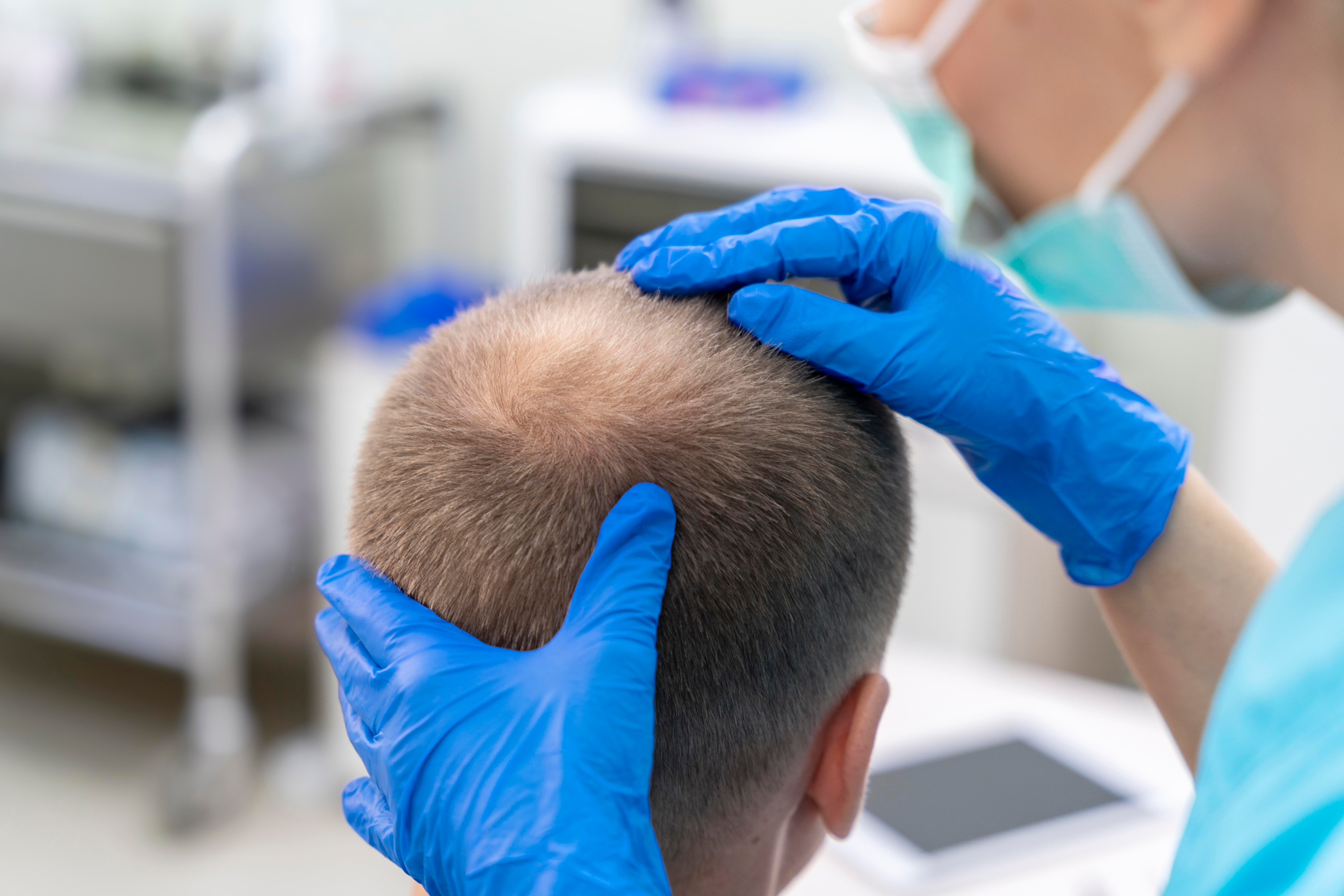 health professionals can treat severe hair loss with multiple hair loss treatment options