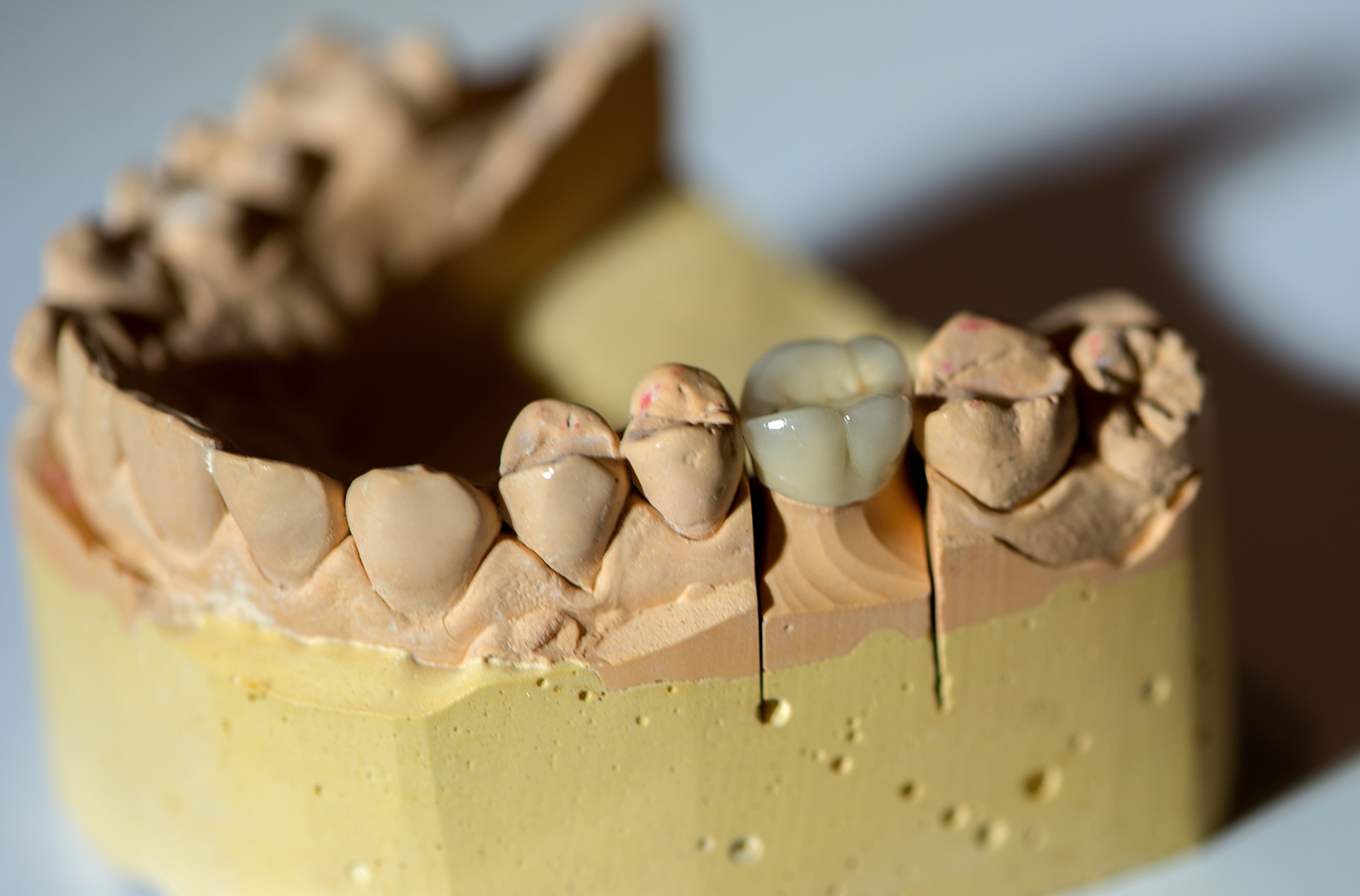 a dental crown placed over an existing tooth on a plaster model