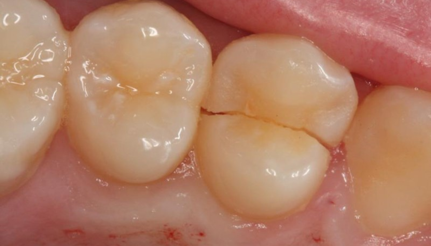 Sprekk i tann: Når du bør ta smerter på alvor 13 Nærbilde av jeksel med tydelig horisontal sprekk gjennom tyggeflaten som viser skade i tannstrukturen.