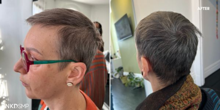 Nicole's before and after SMP hair tattoo results