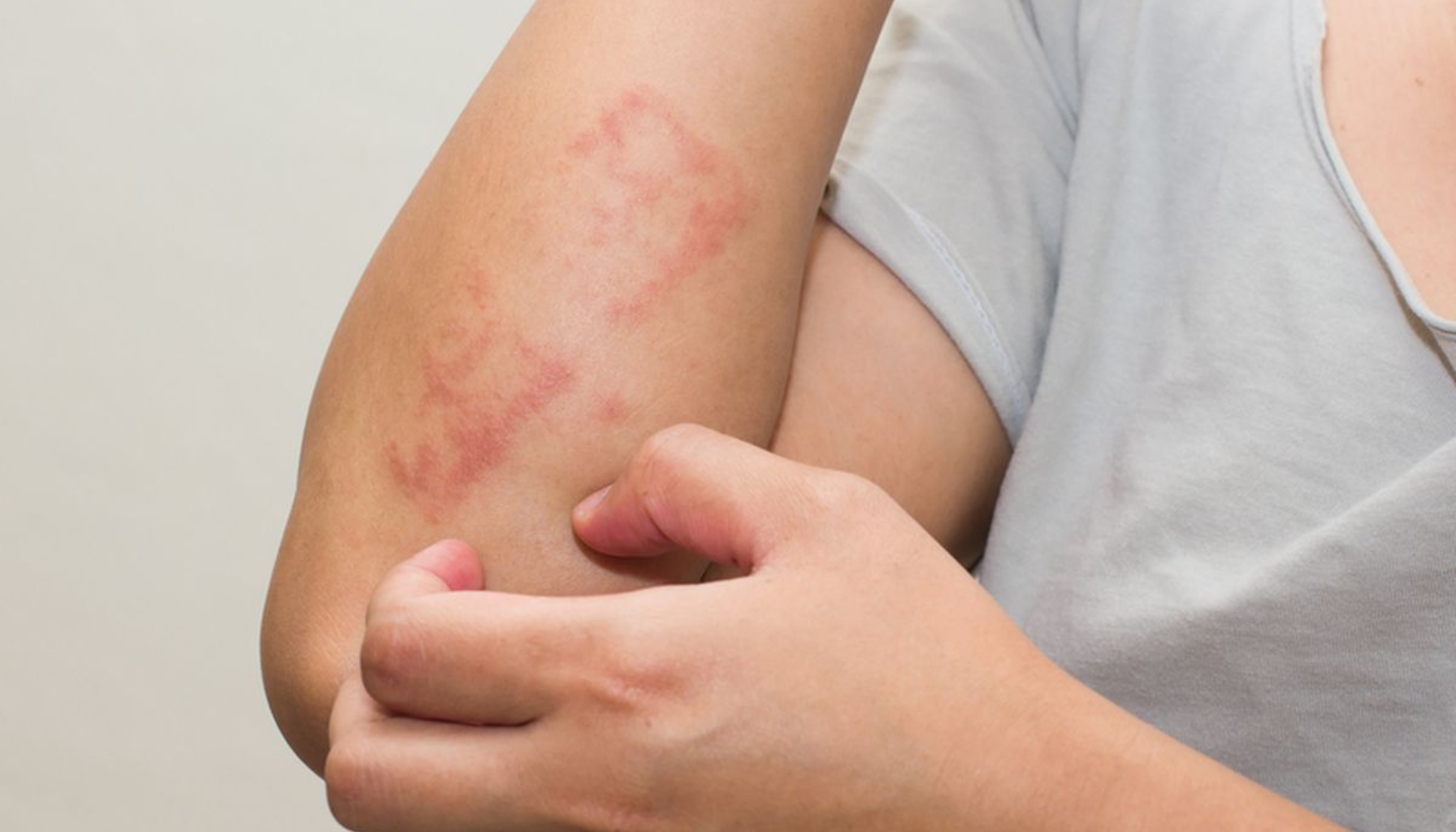 Person klør på rød og betent hud på underarmen, tydelige symptomer på eksem eller hudreaksjon.