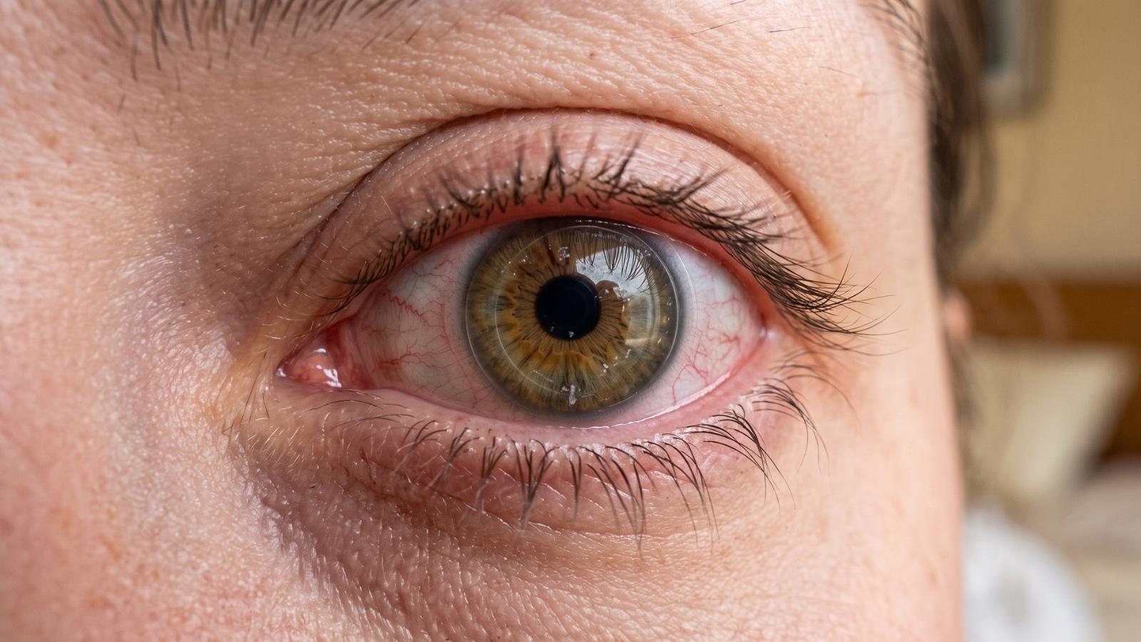 accidentally fall asleep, eye health