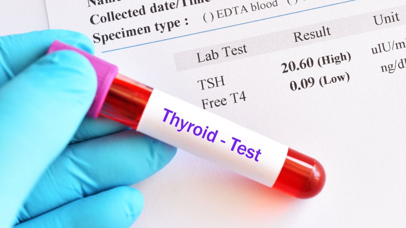 hypothyroidism - congenital hypothyroidism