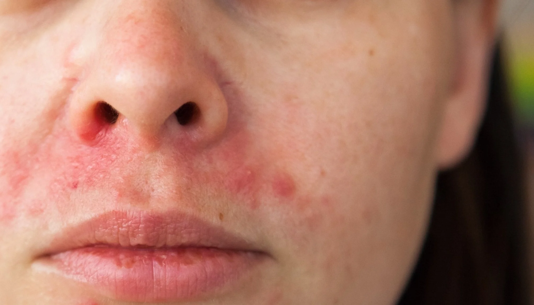 Nærbilde av hud med rødhet og små kviser rundt nese og munn, typisk for perioral dermatitt eller hudirritasjon.