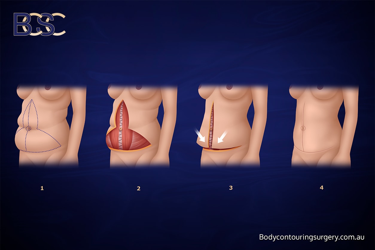 Fleur-de-lis abdominoplasty Fleur de lis abdominoplasty