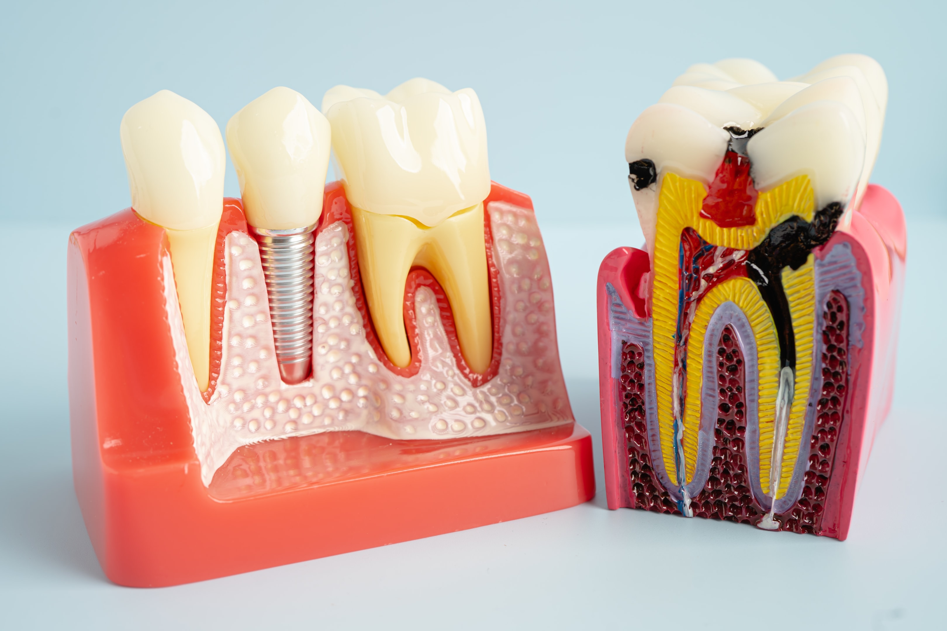 Dental model showing what a dental implant is