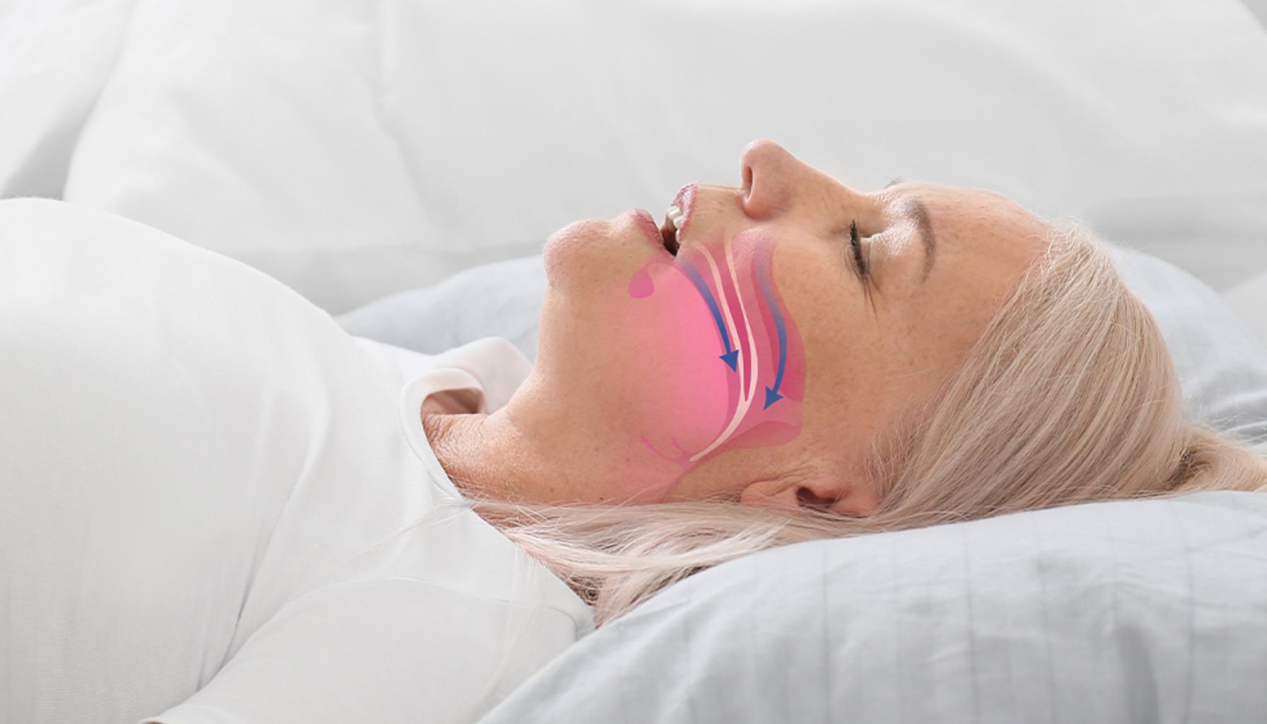 Snorking: Når Det Er Mer Enn Bare Irriterende – Og Hvordan Tannlegen Kan Hjelpe 2 Eldre kvinne sover på ryggen med illustrasjon av luftveier, viser mulig snorking eller søvnapné.