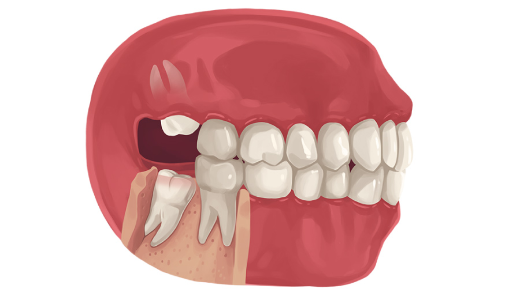 Må man trekke visdomstann: Ikke alltid men ofte lønner det seg 10 Inneklemt visdomstann som vokser skjevt nedover i kjeven og presser mot nabotannen, vist i illustrasjon. må man trekke visdomstann trekke en visdomstann trekke visdomstann fjerning av visdomstenner trekke visdomstenner trekking av visdomstenner trekking av visdomstann bakerst i munnen rundt visdomstannen siste tennene visdomstann les mer slike tilfeller trekke visdomstenner andre tennene tannkjøttet rundt opplever smerter området rundt rundt tannen første dagene visdomstennene visdomstannen tannen bestill time tannlegen bør problemer tannlege fjerne smerter tannkjøttet ofte andre trekking tennene mer får hos gjør dersom tenner flere vondt kommer opplever tilfeller fjerning dine helt fjernes behandlingen inngrepet munnen under trukket vanlig god første området litt betennelse ubehag smerte behandling siste komme derfor plass vurdering slike gjøre alltid trekkes moderne trenger viktig prisen time underkjeven hevelse