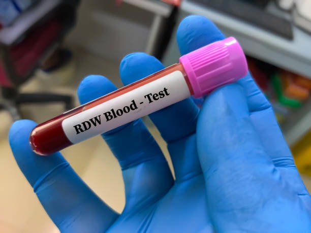 RDW Blood Test: Meaning, Normal Range, High & Low Levels |Cell Distribution Width RDW | Corpuscular Hemoglobin Concentration | White Blood Cells | Blood disorders | Blood draw | Normal RDW Result | Elevated RDW | Distribution Width RDW Test | Mean Corpuscular Hemoglobin Concentration | Folate deficiency Anemia | Inherited Blood disorder | Normal RDW Ranges | High Blood Pressure