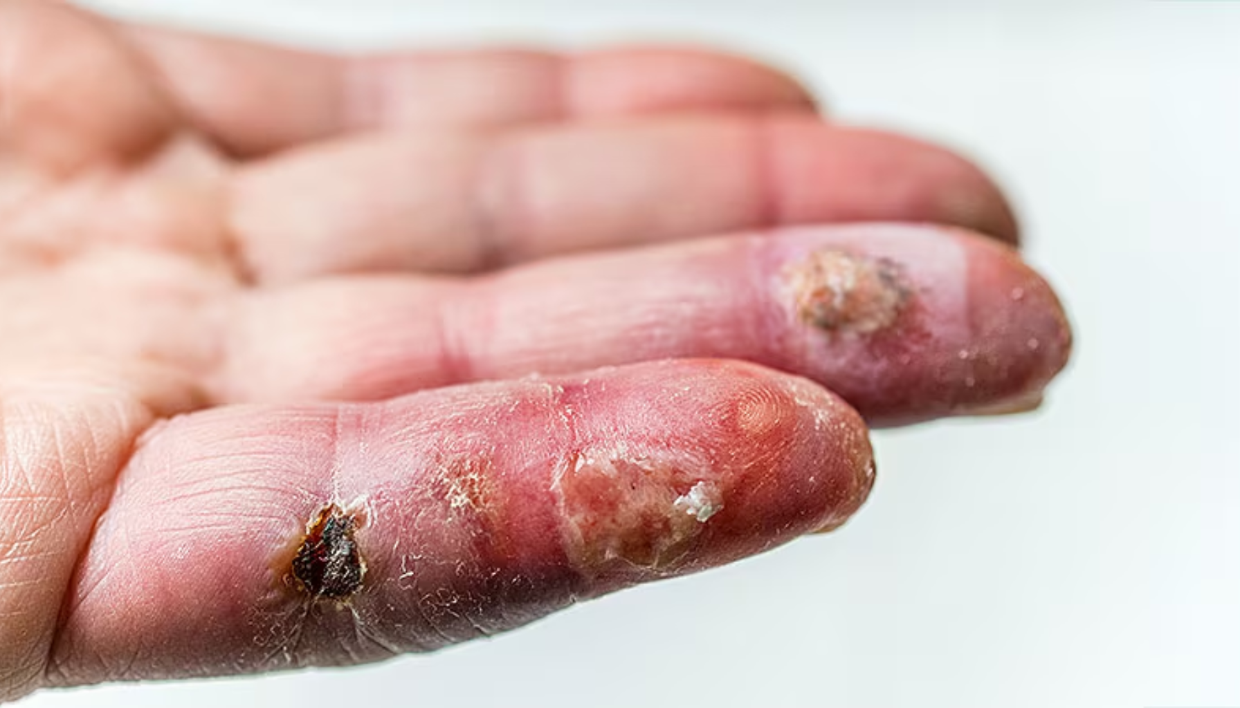 Kjøttetende bakterie: En alvorlig infeksjon du bør kjenne til