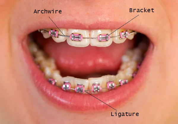 Ceramic Braces Singapore  4 things you need to know