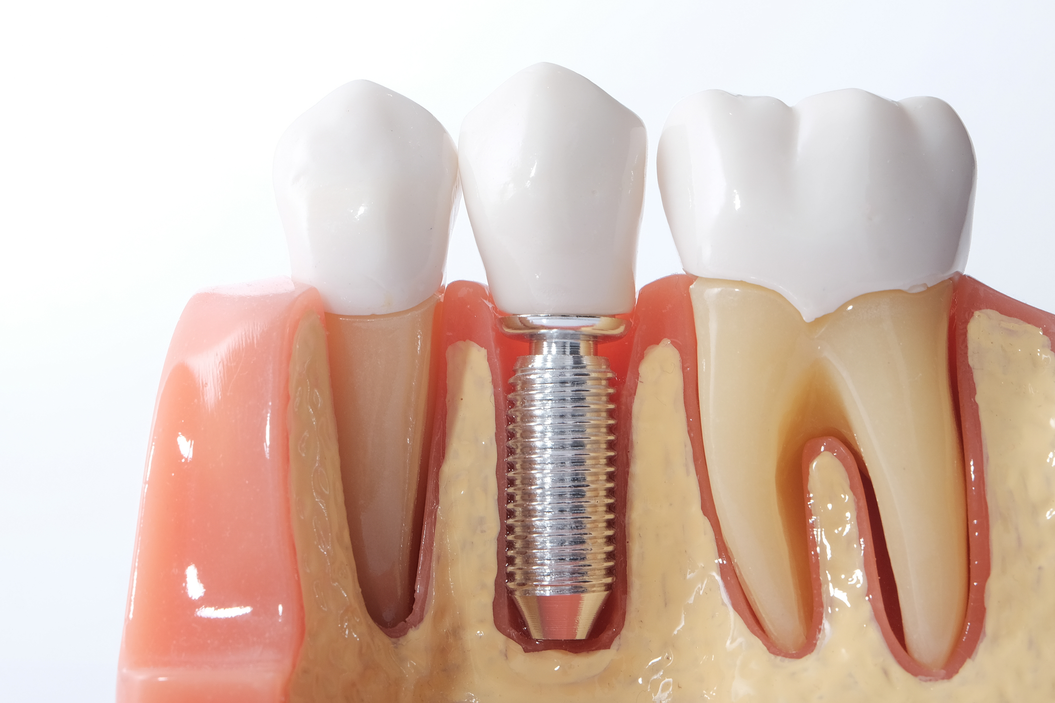 implant surgery or implant therapy model showing a single tooth implant