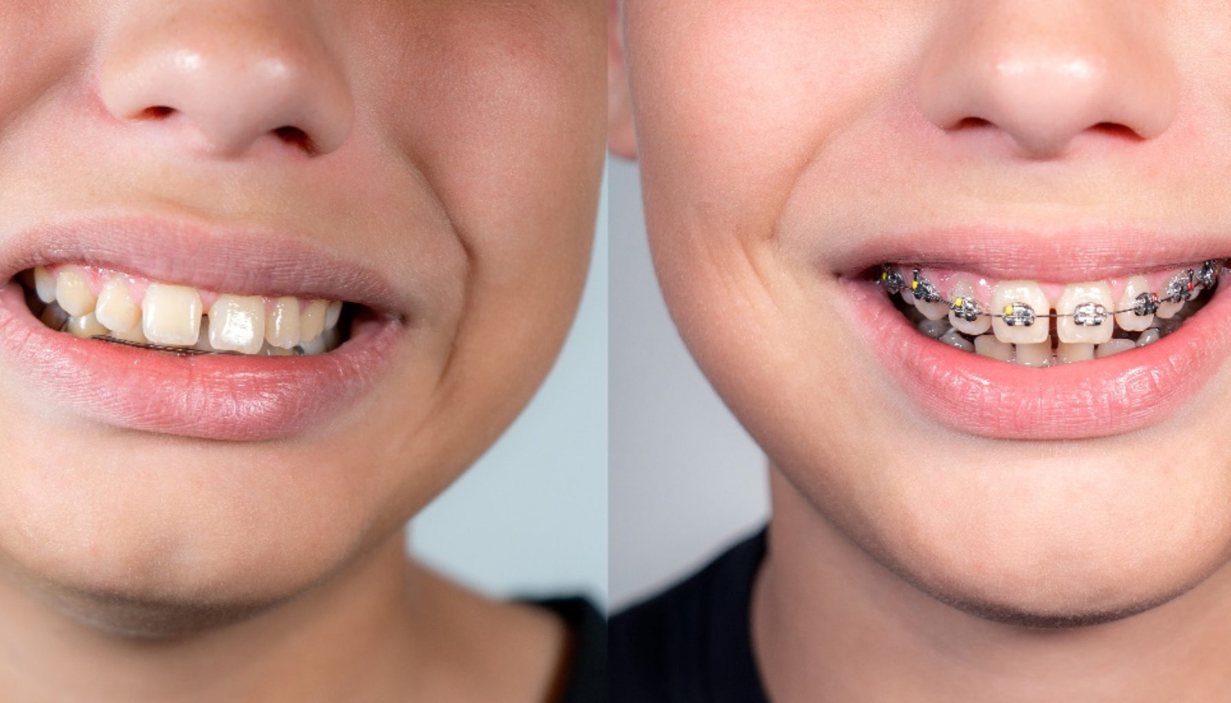 Før-og-etter-bilde av barn med skjeve tenner og deretter med tannregulering, viser starten på ortodontisk behandling for tannjustering.