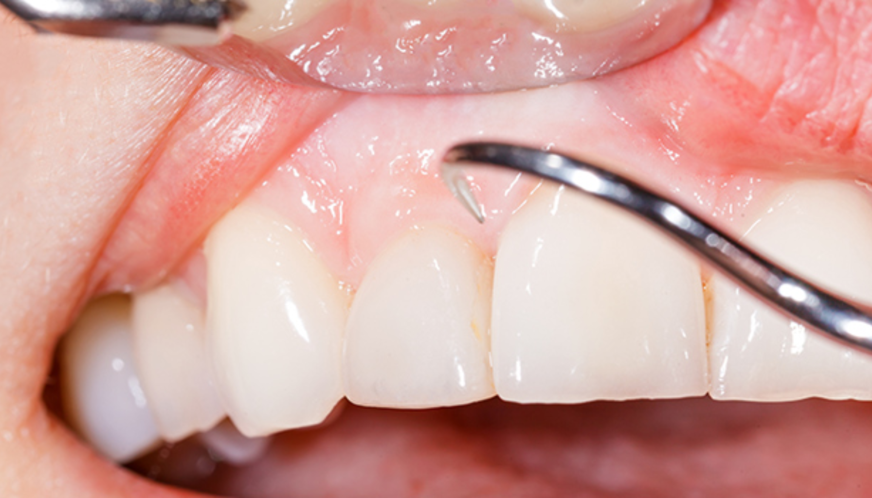 Nærbilde av tannlegeundersøkelse der tannstein fjernes med skrapeverktøy langs tannkjøttkanten på øvre fortenner. hvit tannkjøtt tennene hos tannen tann råd vanligvis innsiden litt bruker finnes svært lege infeksjoner legen annen puss komme oppdatert måneder mens kommer