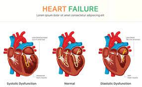 HFrEF and HFpEF