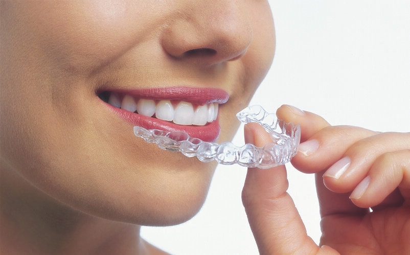 How Long Does Invisalign Take? - 9e51c1a2 5cd2 40b5 a293 d2b4f1a06f4f
