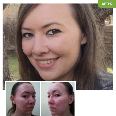 Mesa Coral suffered from acne into adulthood, until she was able to get rid of her acne with Exposed.