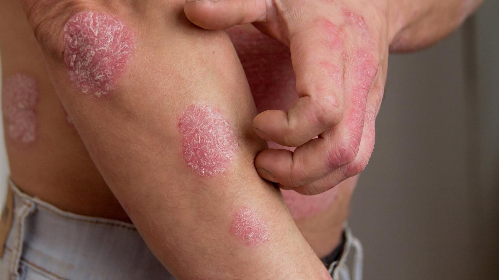 psoriasis treated