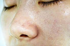 skincar for Oily or acne prone skin