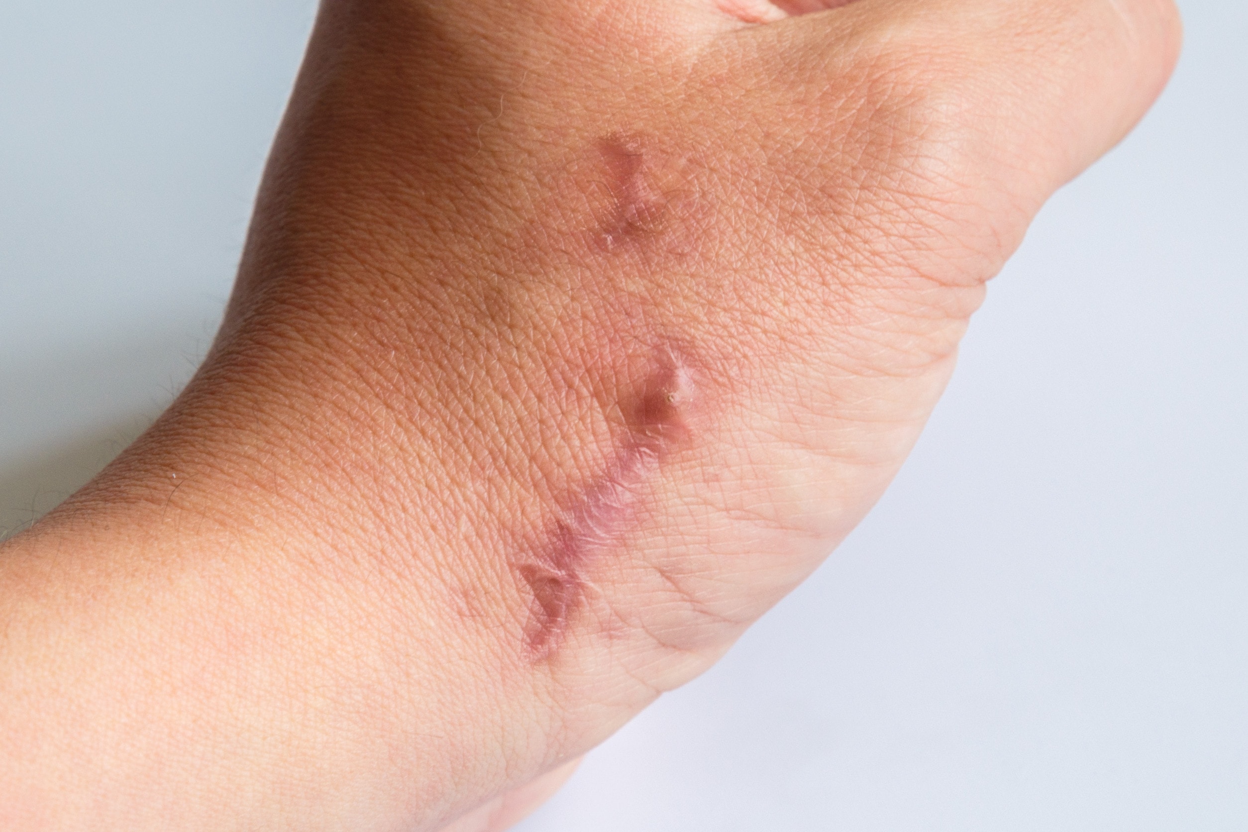 A pink scar on a hand with a white background