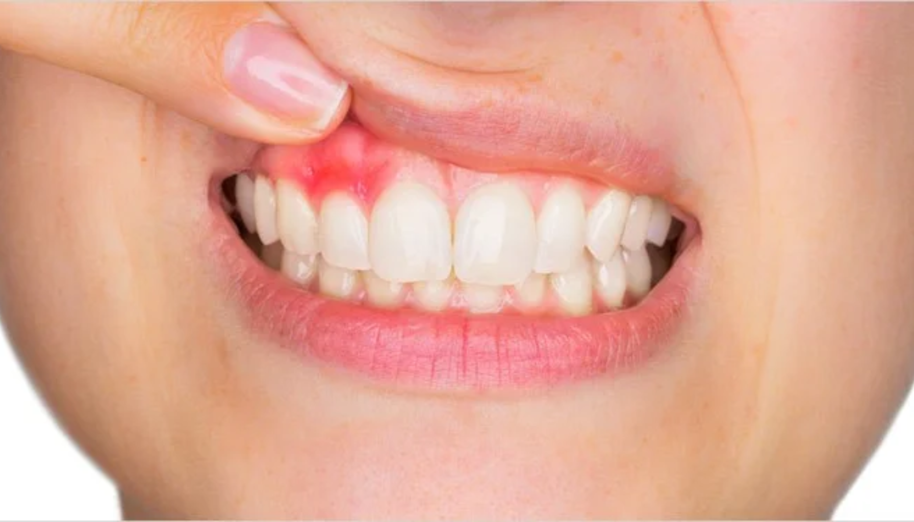 Rødt og hovent tannkjøtt over fortennene, som viser tegn på betennelse eller mulig tannkjøttinfeksjon.