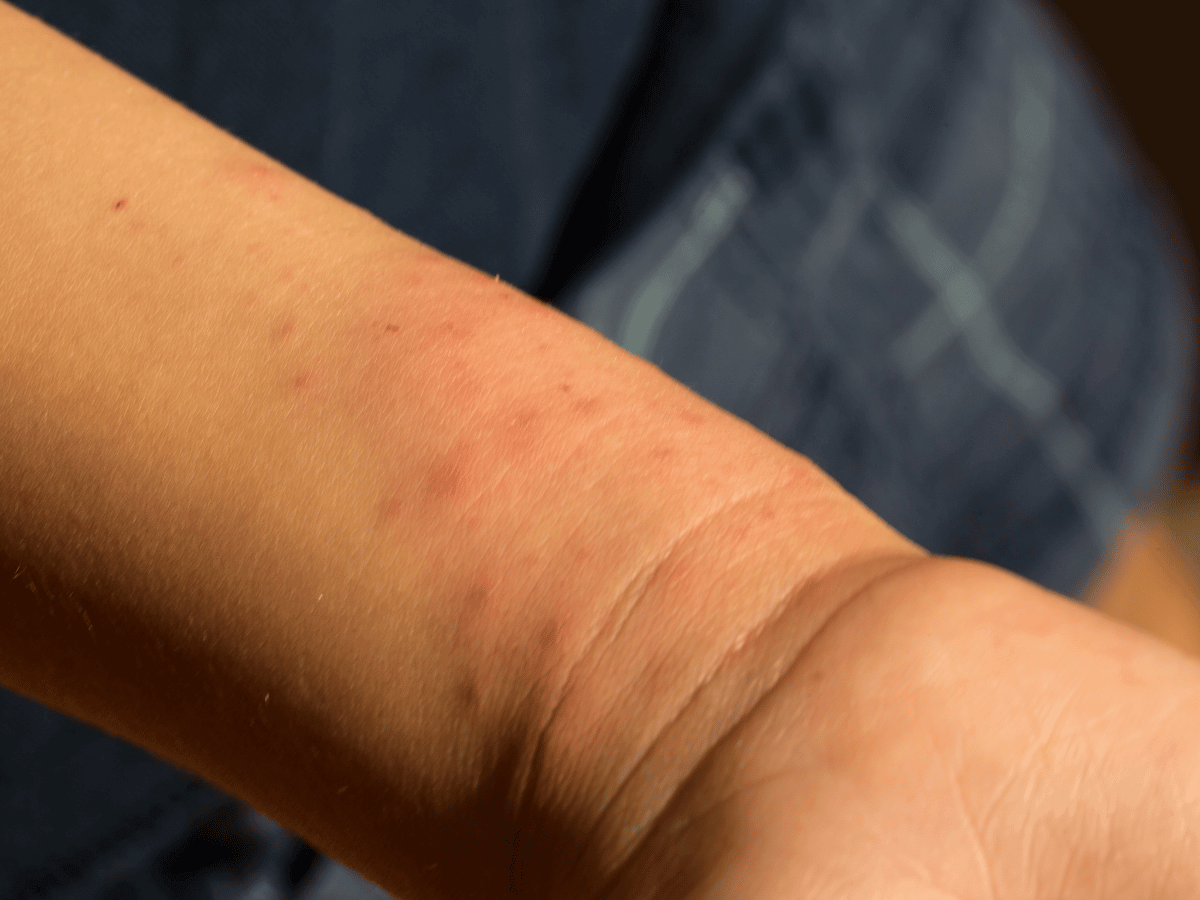 You may be confused of allergic reaction appearance on your skin, but it can be already the bedbug bites