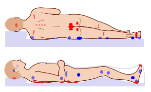 What Is A Pressure Ulcer