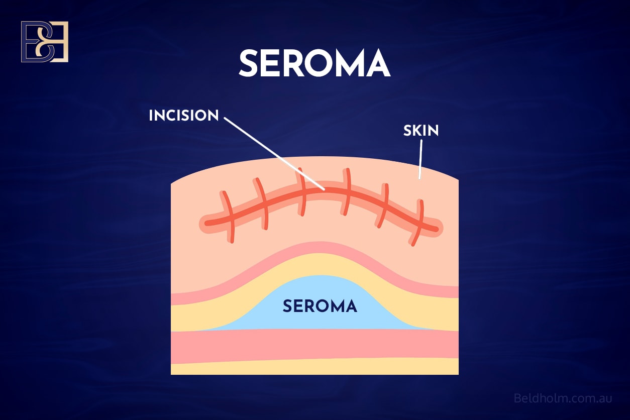 Seroma