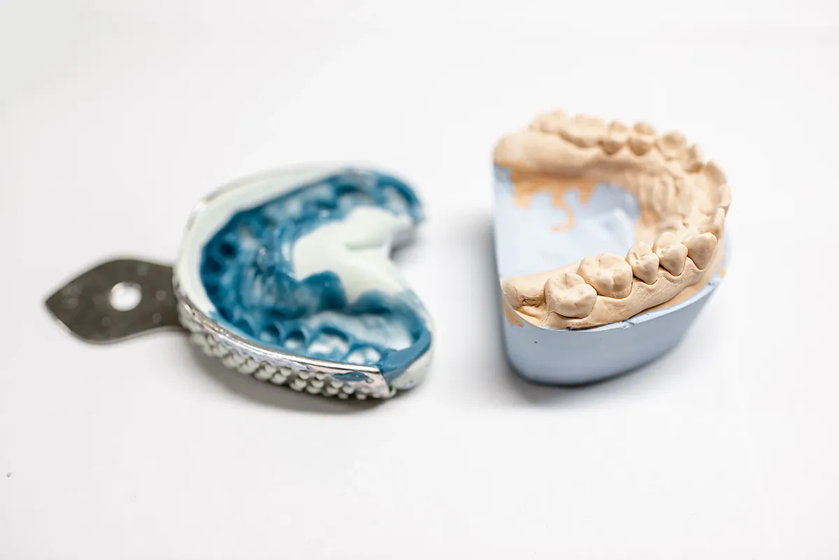 Dental impression molds showing tooth impressions in blue and beige