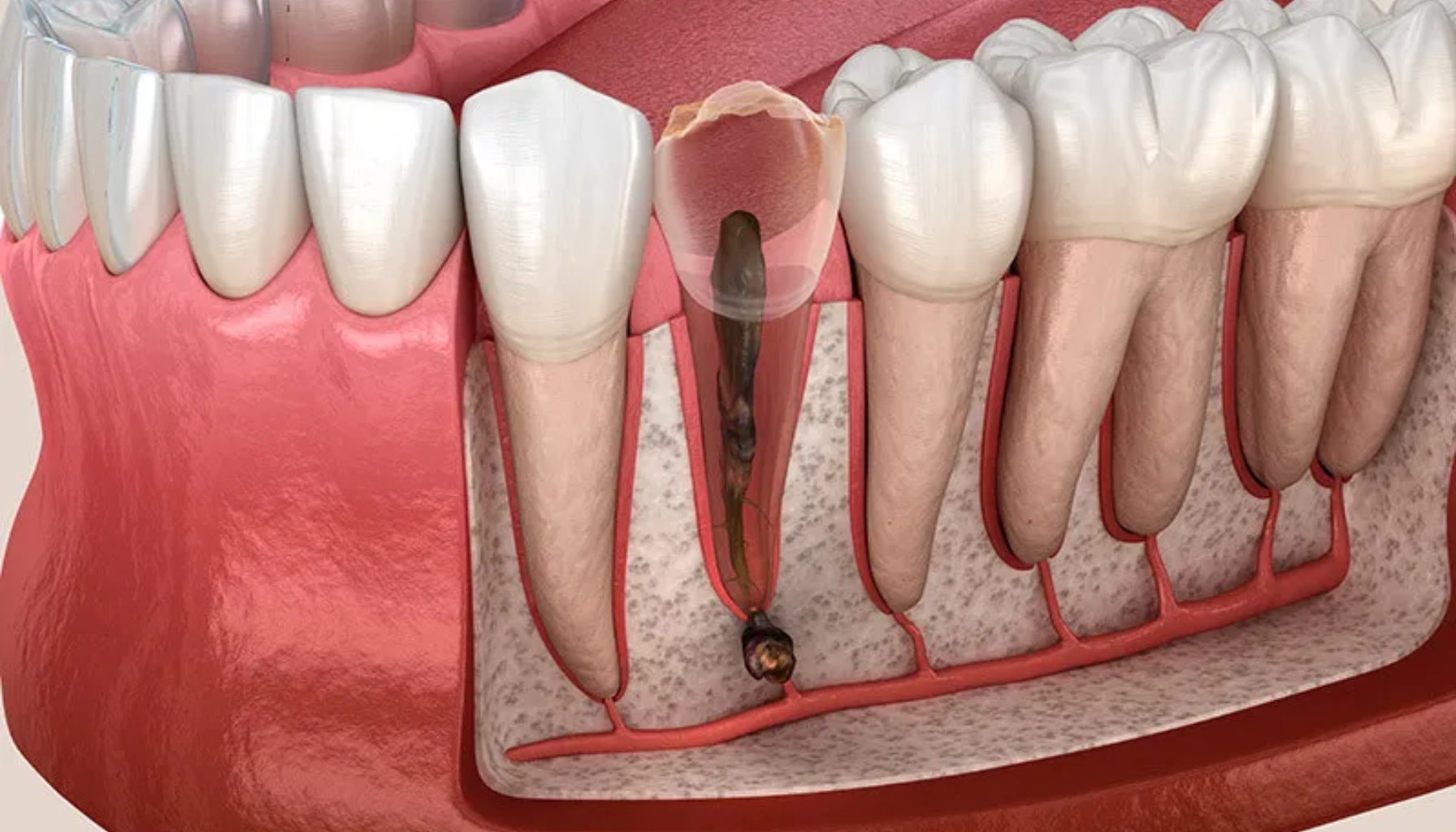 Illustrasjon av tann med alvorlig rotinfeksjon og nekrose, viser ødelagt nervevev og infeksjon som har spredt seg til rotspissen og kjevebenet.