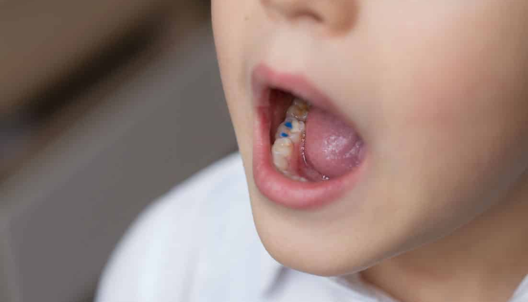 Mistet fylling i tann: Hva gjør du?