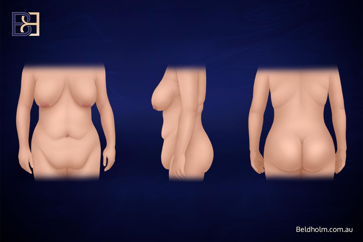 Vitamin A (Retinoid) Before and After Body Contouring Surgery: A Guide for Post Weight Loss Patients 9 a12d9c48 2687 433b b07e 9422bf37d02a