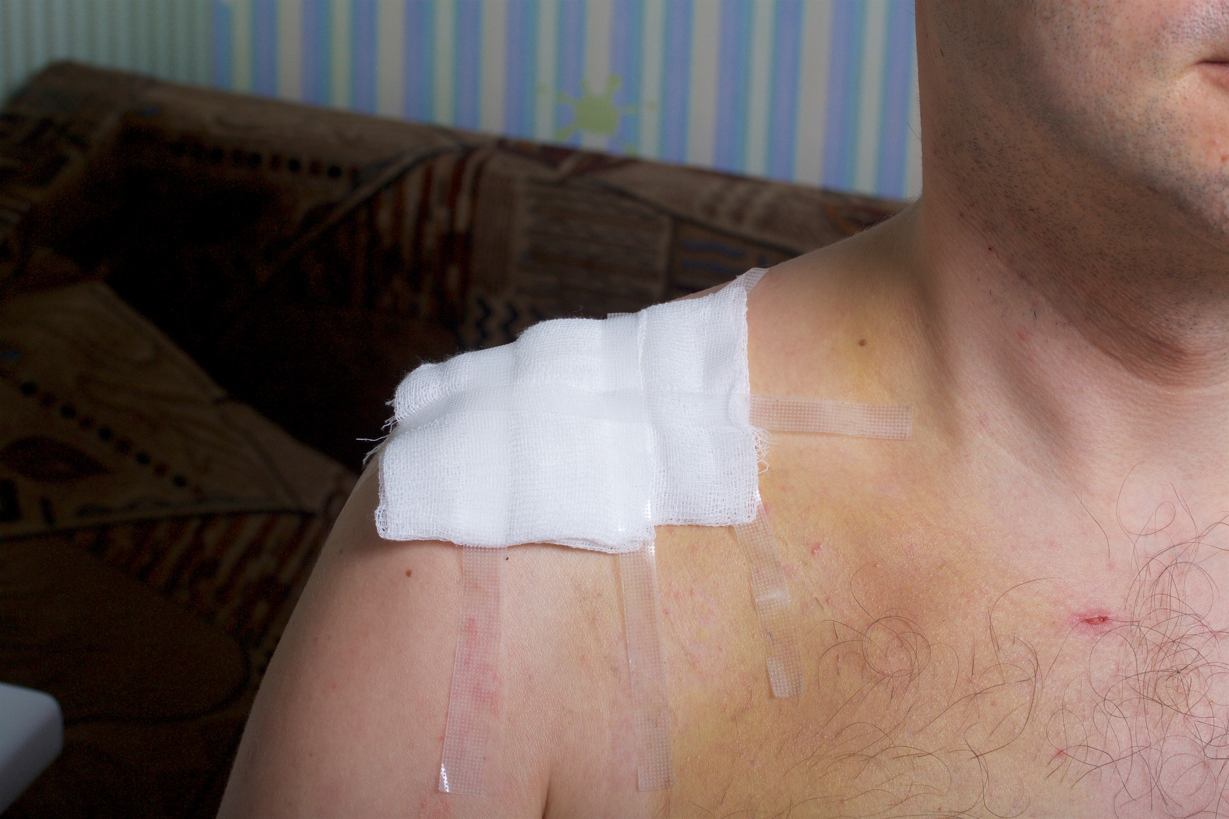 A piece of gauze covering a shoulder wound that will soon become a scar