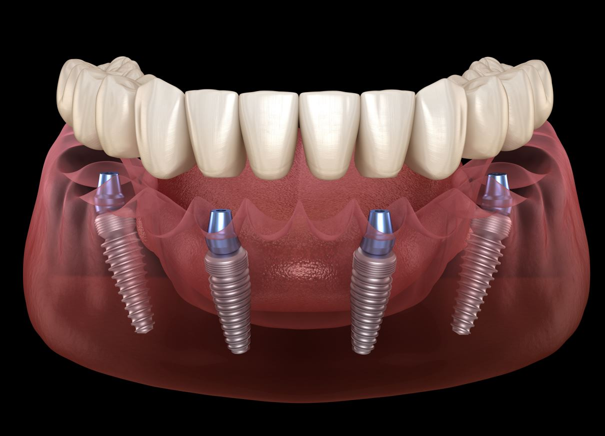 A patient brushing their dentures