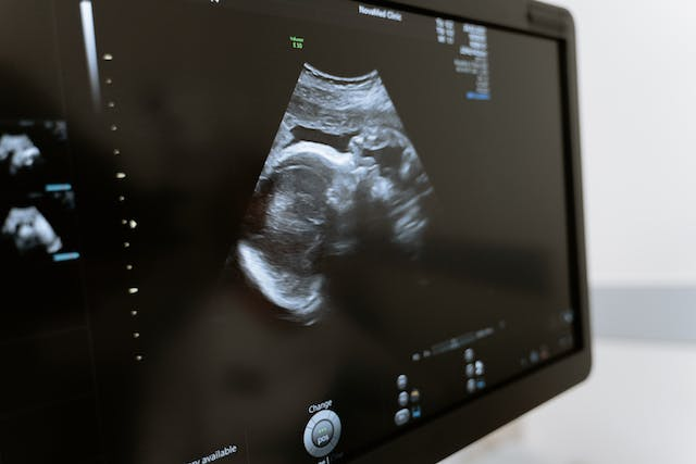 BPD Measurement in Ultrasound: Tracking Foetal Growth – MyDiagnostics