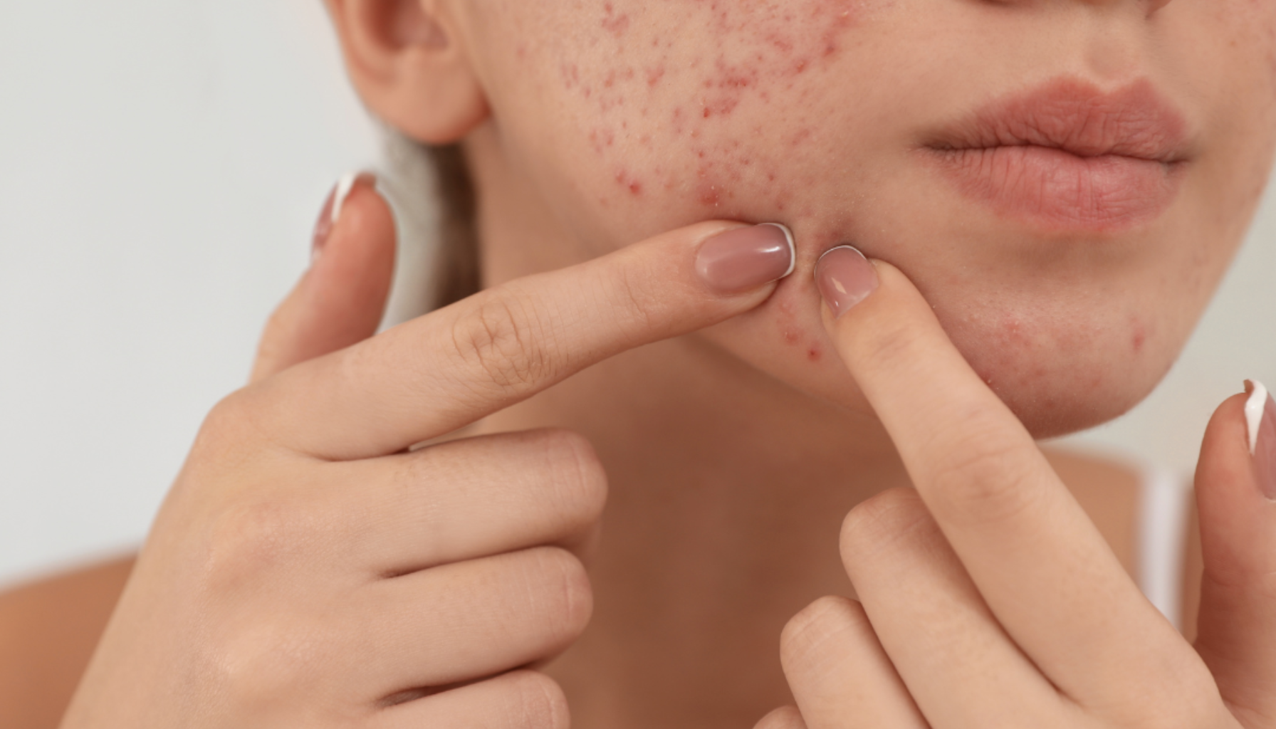 Kviser rundt munnen: Årsaker og behandling Kviser rundt munnen: Årsaker og behandling