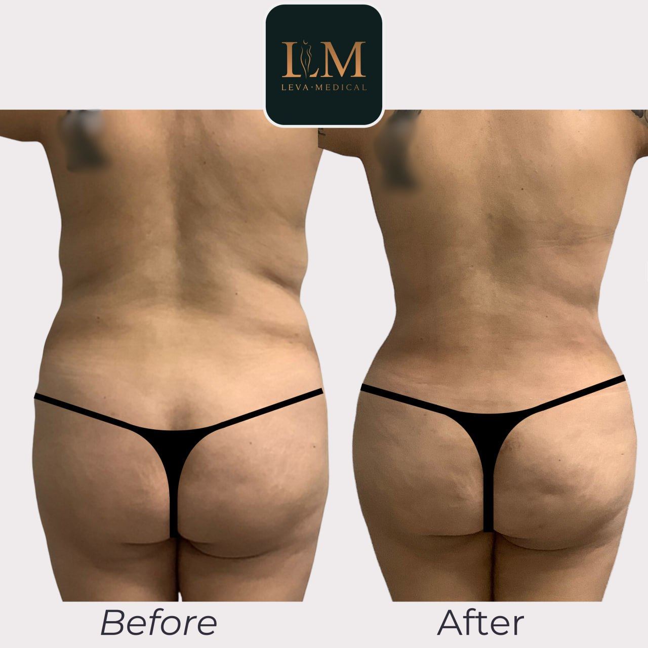 Before and after photos of liposculpture