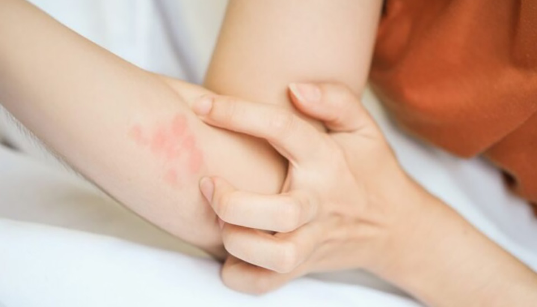 Person klør på armen med rødt, irritert utslett, viser tegn på allergisk reaksjon eller hudirritasjon.