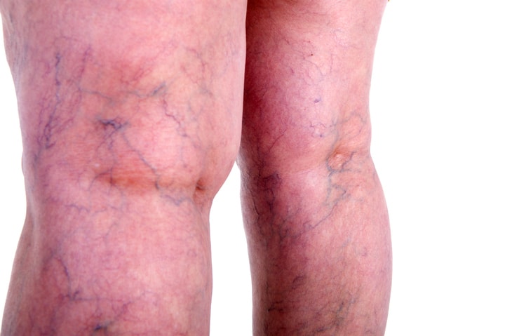 Photo of the back of a person's legs, showing visible spider veins. The image highlights the appearance of small, web-like veins near the surface of the skin.